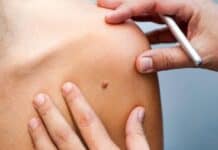 Tigre promueve la campaña de control "Salva Tu Piel" tigre-campania-cancer-piel